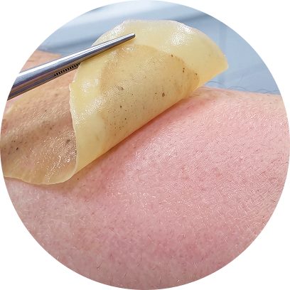 리팟 색소 치료